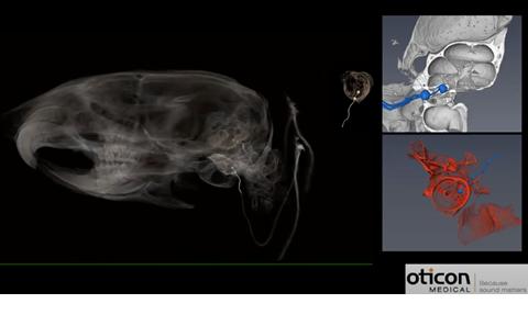 Electrode-tissue interface in cochlear implantats