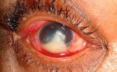 Infected eye