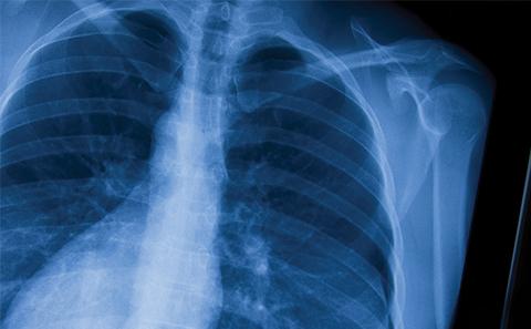 Reducing falls for people with Parkinson's