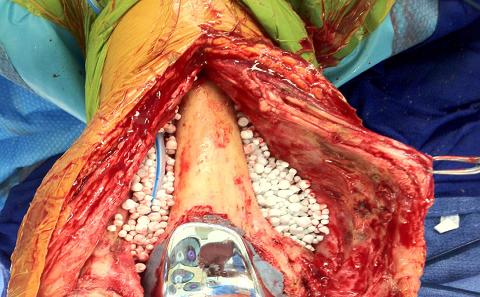 Prosthetic Joint Infection 