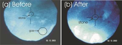 X-rays of stones before and after