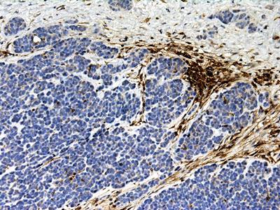 A DFTD biopsy stained for B2-microglobulin (MHC class I). Host stromal cells are stain for B2-microglobulin (brown), while DFTD cells (blue nuclei) are B2-microglobulin negative
