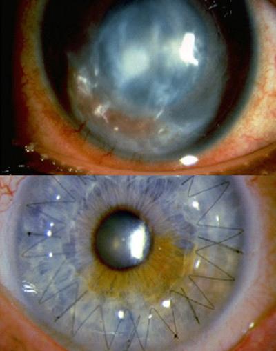 Before and after corneal transplant