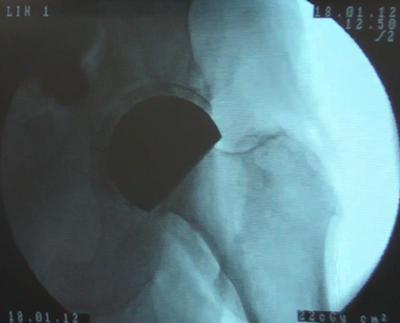 X-Ray of the Implant System in a Trial Cadaver Surgery