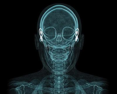 Xray of audio implants
