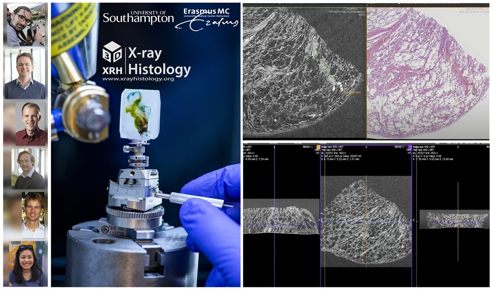 Pathogenesis of lethal respiratory COVID-19