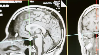MRI scan of a human head showing the brain in profile