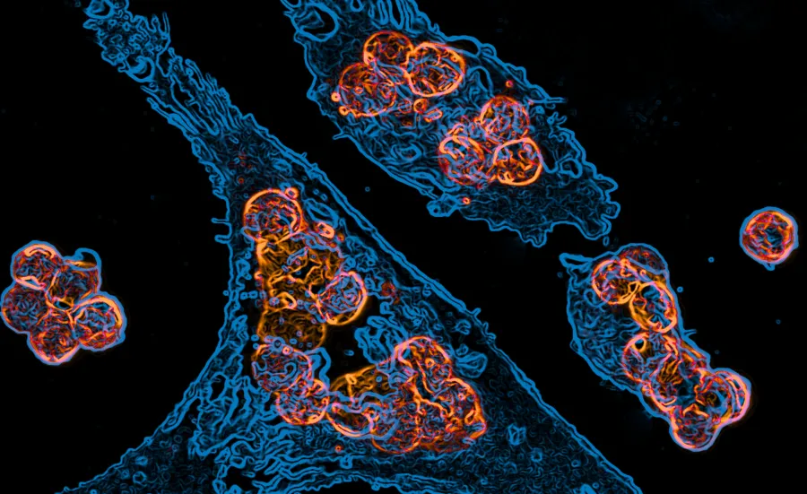 Cancer cells under a microscope