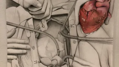 Drawing of a heart transplant operation