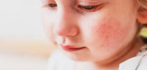 A close-up stock image of a young child with an outbreak of eczema on her cheek.