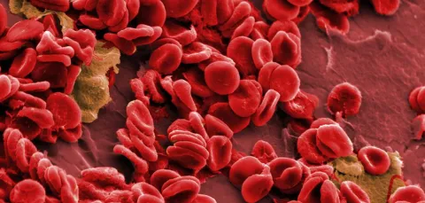 Close-up view of red blood cells on a syringe needle, interspersed with a cluster of white blood cells or platelets