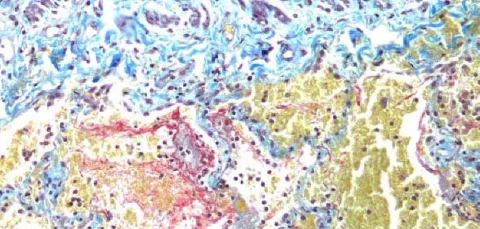Microscopic view of a stained tissue section with purple, blue, yellow, and red areas.
