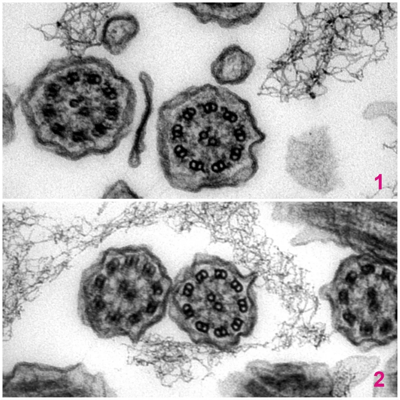 1. A transmission electron microscope image of a single healthy cilium in cross section. The axonemal structure of microtubules is correct and the dynein arms are present.  2. A transmission electron microscope image of a single cilium in cross section from a patient with Primary Ciliary Dyskinesia. The axonemal structure of microtubules is correct however the dynein arms are absent.